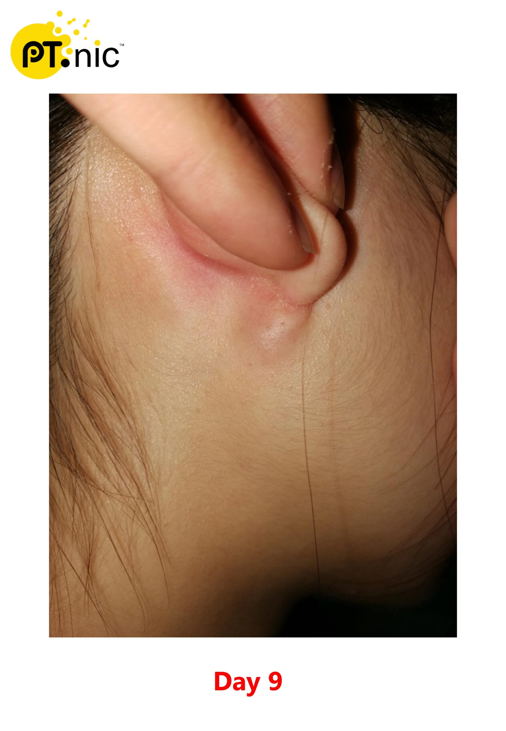 Atheroma 粉瘤 Case_page-0003