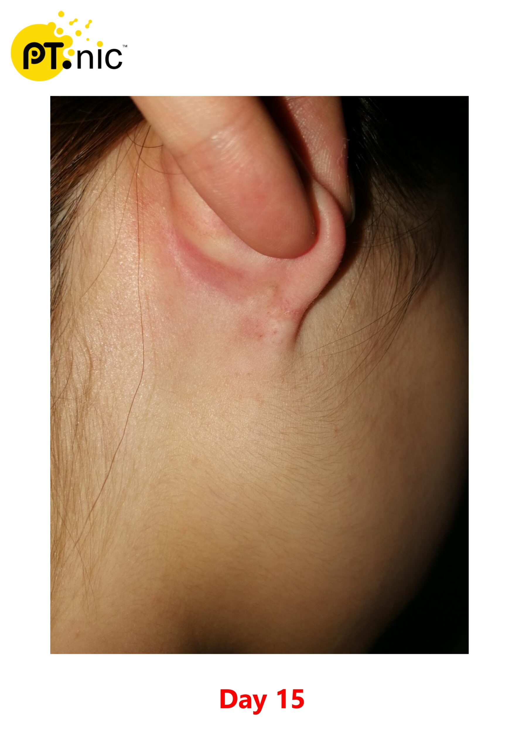 Atheroma 粉瘤 Case_page-0004