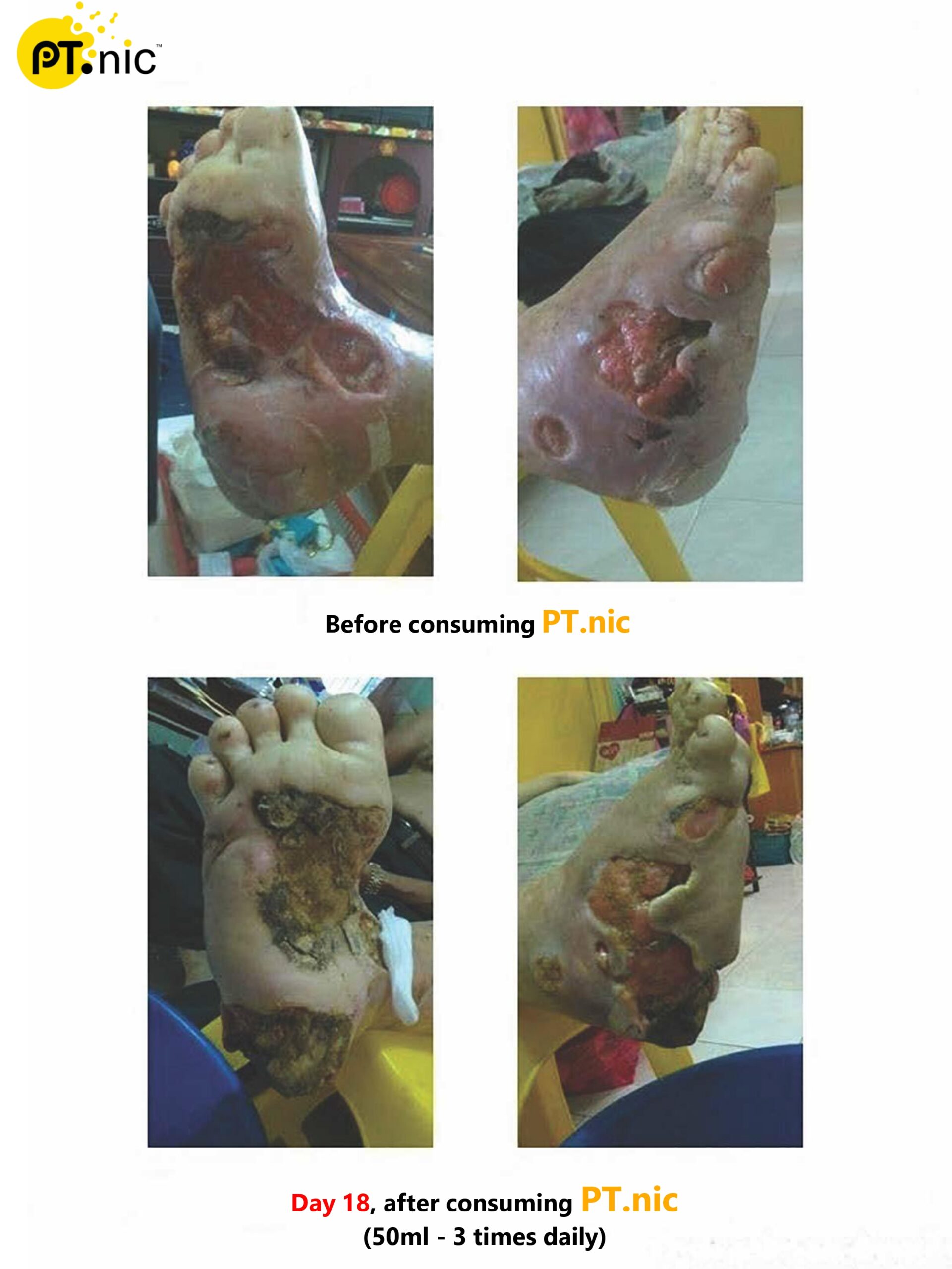 Diabetes Leg Case_page-0001