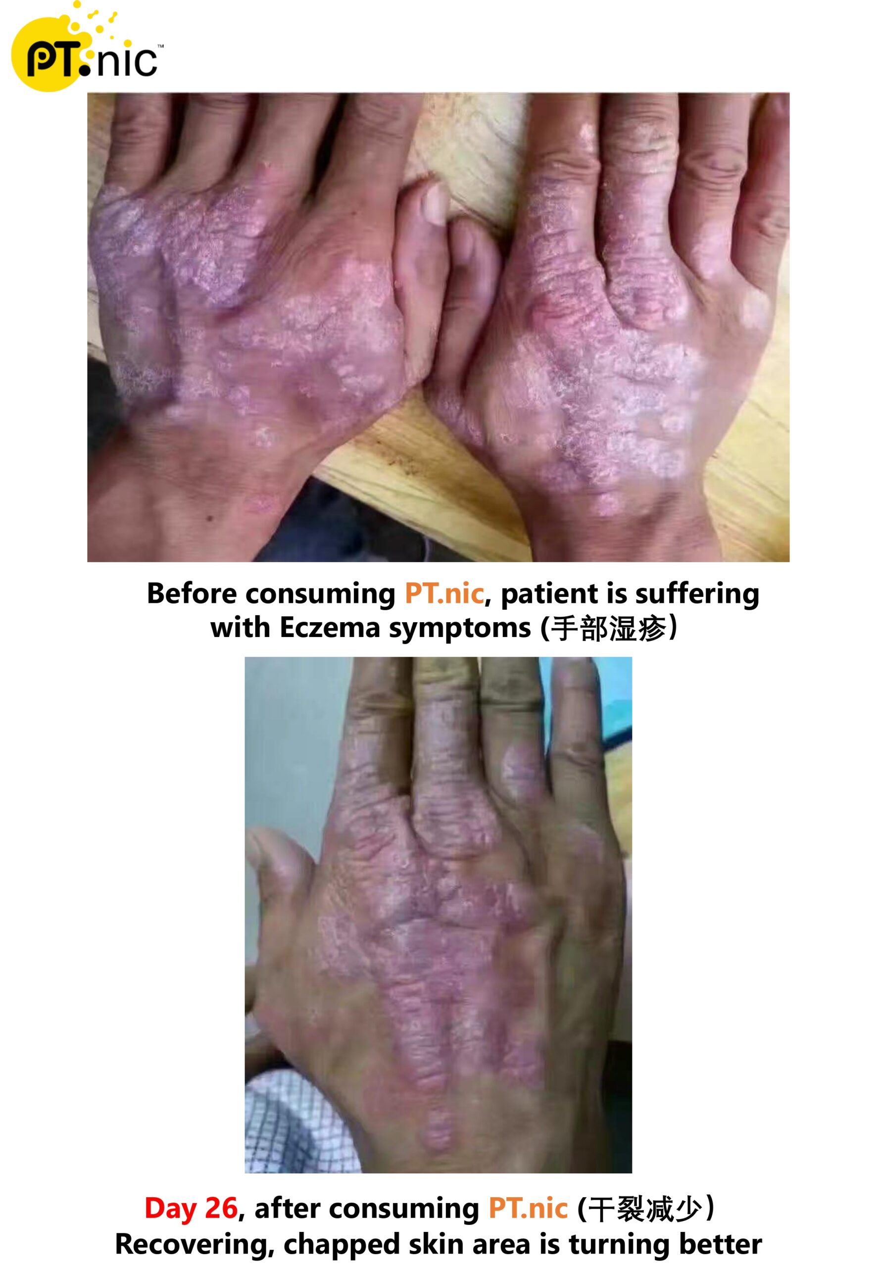 Eczema （湿疹）Case_page-0001