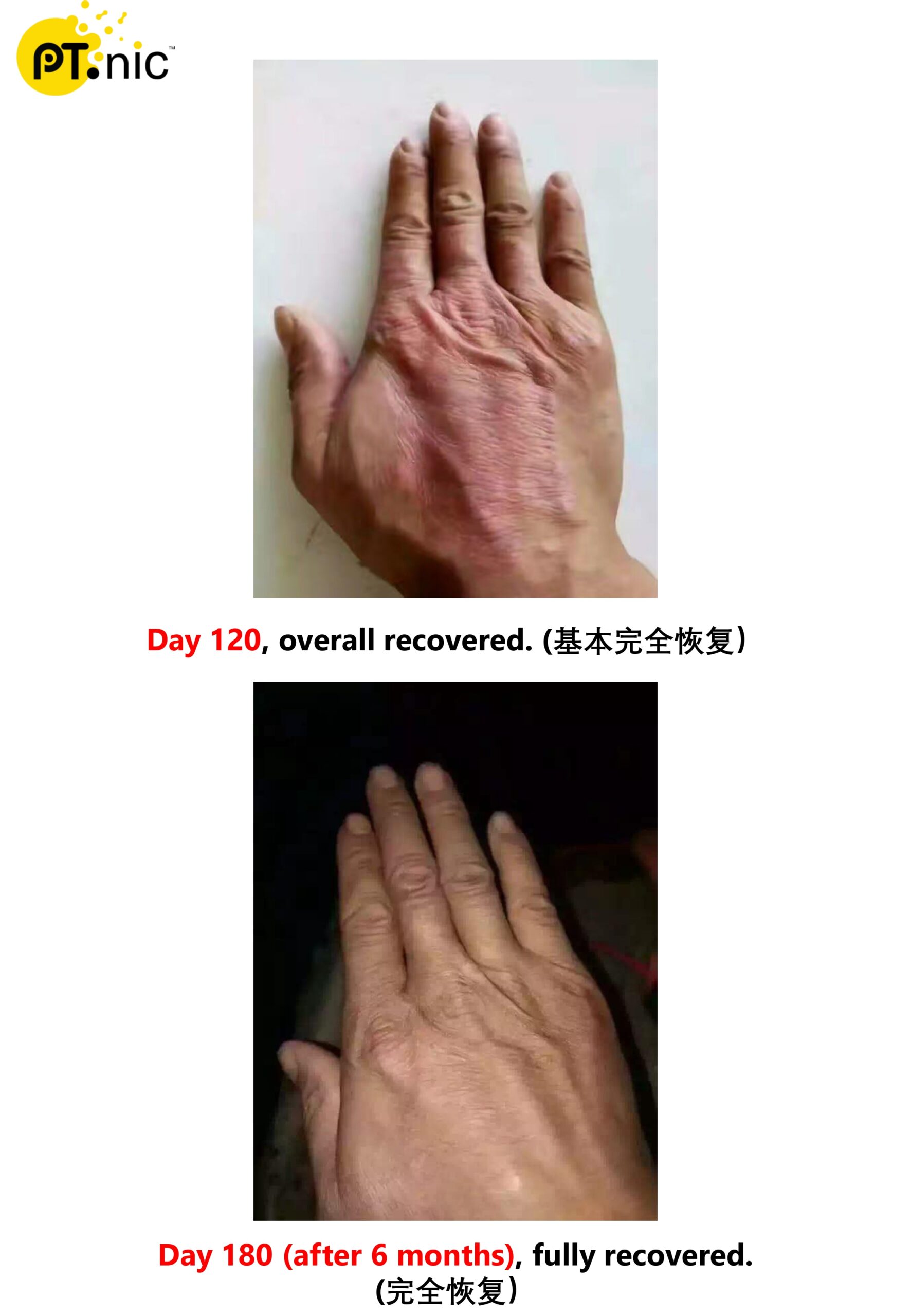 Eczema （湿疹）Case_page-0002